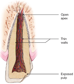 illustration of injured tooth - traumatic dental injuries