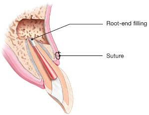 picture of tooth with root end filling