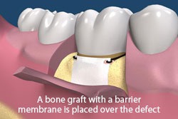 Photo of bone graft - Guided tissue barriers and bone grafting