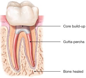 Picture of tooth with core build up