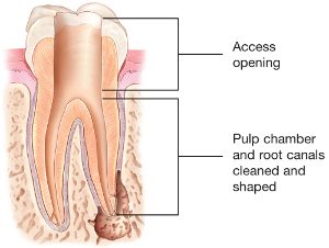 picture of tooth cleaned and shaped