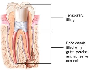 picture of tooth with root canal