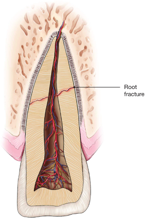 illustration of root fracture - traumatic dental injuries