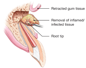 picture of tooth with inflamed tissue - apical surgical repair -