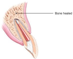 Picture of tooth with bone healed