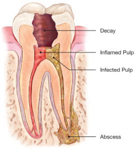 Picture of tooth with inflamed pulp