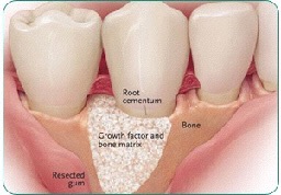 Picture of bone matrix - Guided tissue barriers and bone grafting