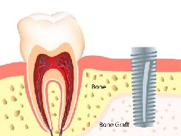 Illustration of bone graft - Guided tissue barriers and bone grafting