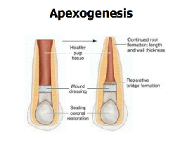 Illustration of apexogenisis - apexogenesis & apexification
