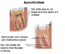Illustration of apexification - apexogenesis & apexification