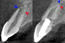 x-ray of tooth - regenerative endodontics