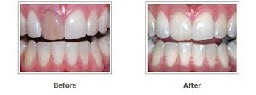 Photo teeth before and after bleaching and whitening - intra-canal bleaching and whitening
