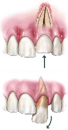 illustration of injured tooth - traumatic dental injuries