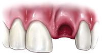 illustration of missing tooth - traumatic dental injuries