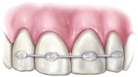 illustration of braces on teeth - traumatic dental injuries