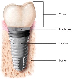 illustration of implant - Extractions and Dental Implants
