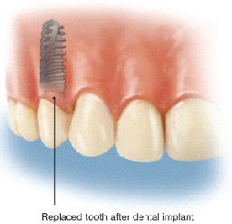 illustration of dental implant - Extractions and Dental Implants