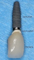 photo of dental implant - Extractions and Dental Implants