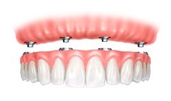 illustration of dental implants - Extractions and Dental Implants