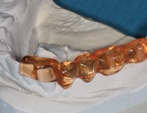 CBCT Guided Surgery: Accurate, Predictable, and Economical
